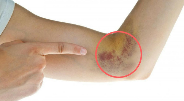 Picture 3 of Early manifestations of diabetes that you should take precautions