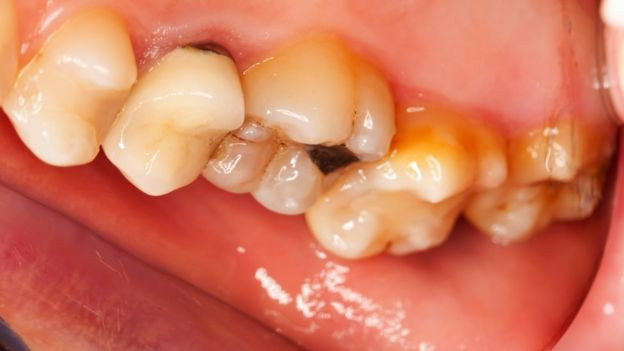 Picture 2 of Eat and drink with acidic substances: chewed and swallowed, don't hold on