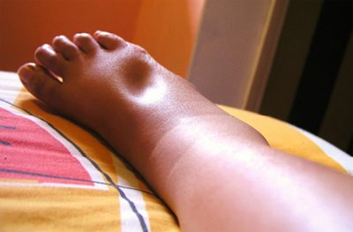Picture 2 of Edema - a sign of many dangerous diseases