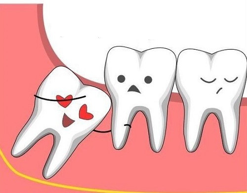 Picture 2 of Eliminate false thoughts about wisdom tooth extraction