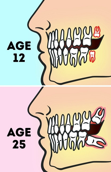 Picture 3 of Eliminate false thoughts about wisdom tooth extraction