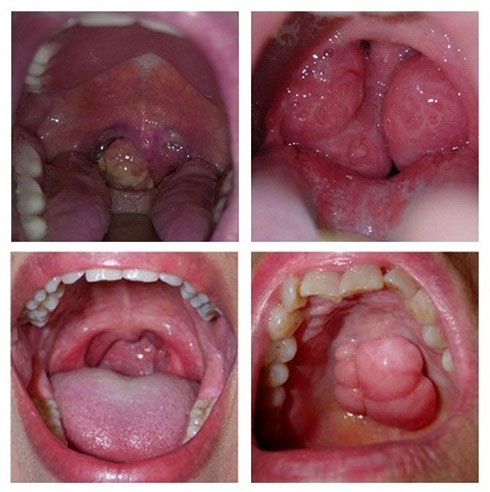 Picture 2 of Essential knowledge about throat cancer