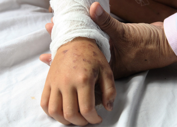 Picture 2 of Experts point out 5 mistakes when first aid for bitten by poisonous snakes