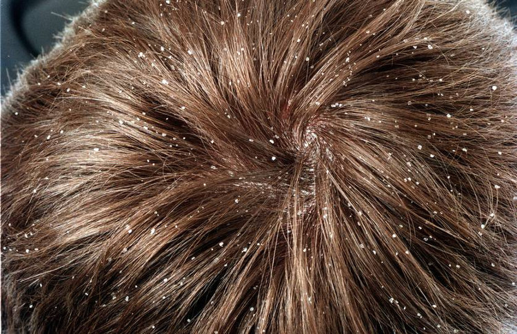Picture 1 of Explain the status of dandruff often appear in the summer