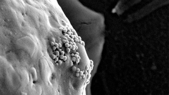 Picture 1 of Explosive gold nanoparticles can eradicate cancer cells to the root