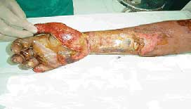 Picture 2 of Fabrication of membrane for treatment of oil-impregnated burns