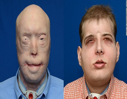 Picture 1 of Face transplants startling the world
