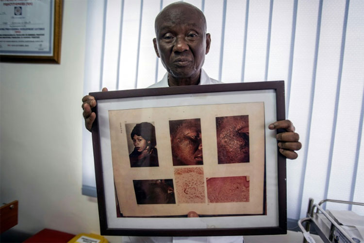 Picture 4 of FDA warns of hazards from skin bleaching