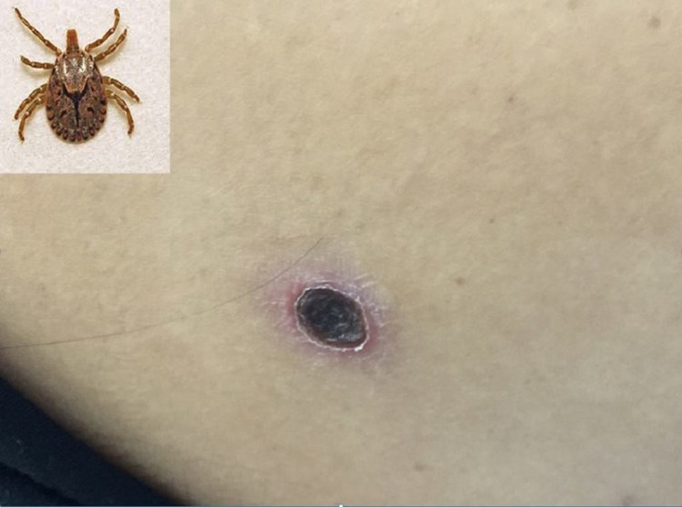 Picture 1 of Fever is difficult to detect, can lead to death