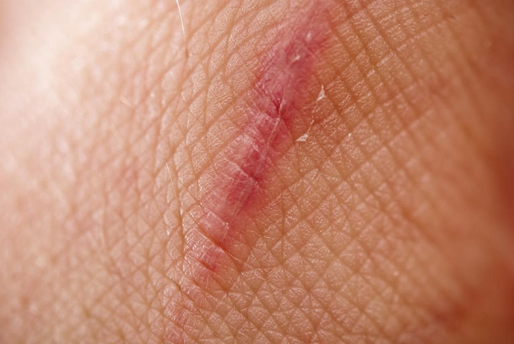 Picture 3 of Finally science also found a way to heal without leaving a scar