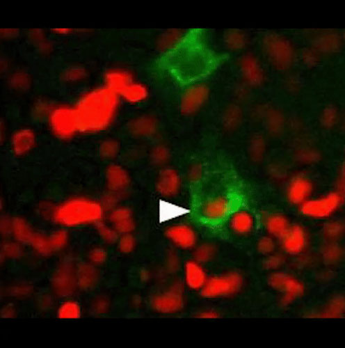 Picture 1 of Find a mechanism that makes cancer 'avoid' chemotherapy