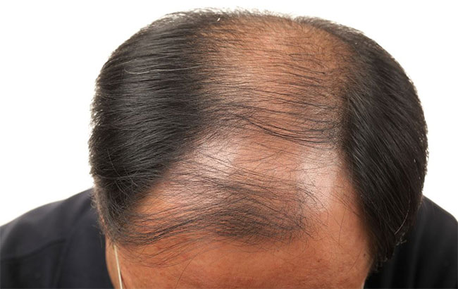 Picture 1 of Find a way to use scent to treat baldness