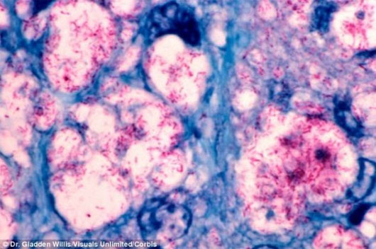 Picture 1 of Find out the oldest infectious bacteria of humanity