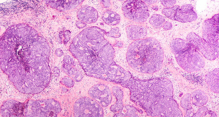 Picture 1 of Finding 110 new genes causes breast cancer