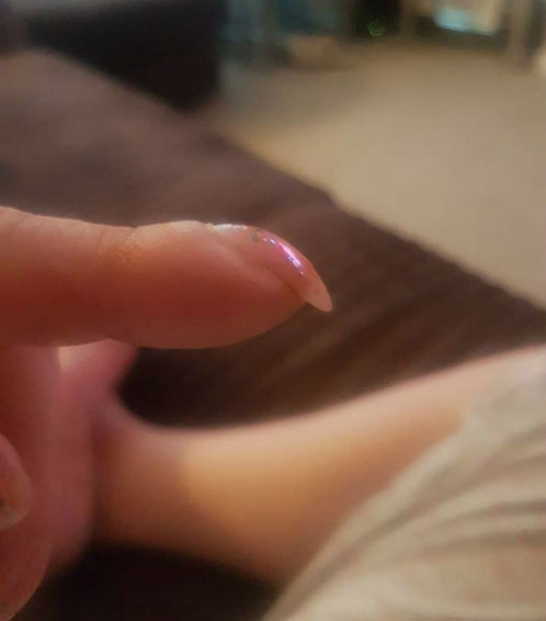 Picture 1 of Fingernails overlap warn lung cancer