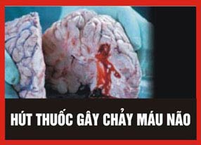 Picture 3 of Five warning images must be printed on cigarette packs