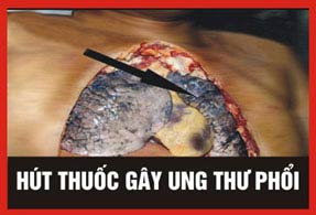 Picture 4 of Five warning images must be printed on cigarette packs