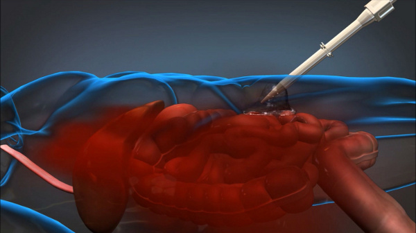 Picture 1 of Foam hemostatic internal injury