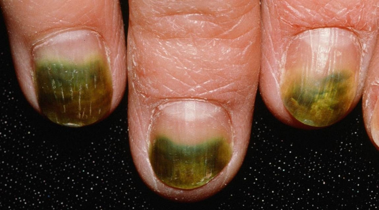 Picture 3 of Forget sharks, these 5 bacteria also make you