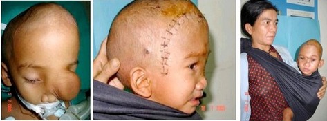 Picture 1 of Free face cranial deformities for poor children