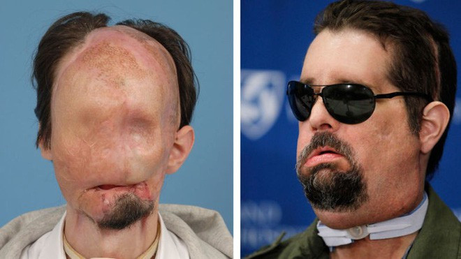 Picture 3 of French doctors have made history, when transplanted a second face for the same person