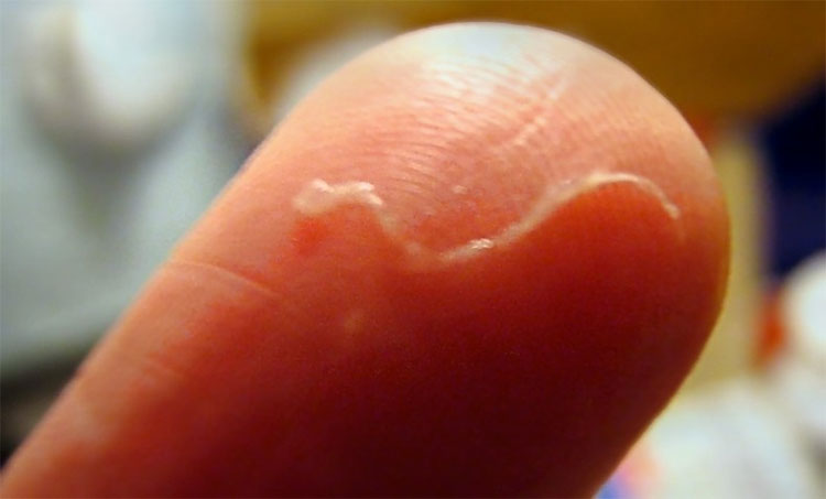 Picture 2 of Frightened to know the horrifying truth behind a small, harmless little lump on his face