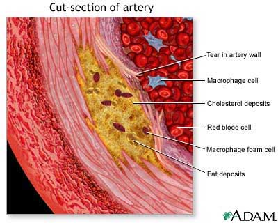Picture 2 of 'Garbage scanner' for arteries