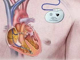 Picture 1 of Genetic detection increases the risk of atrial fibrillation