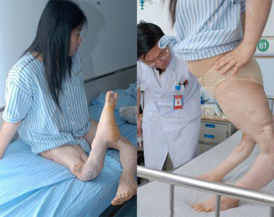 Picture 1 of Girl has strange curved legs