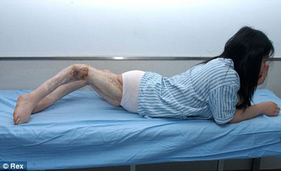 Picture 2 of Girl has strange curved legs