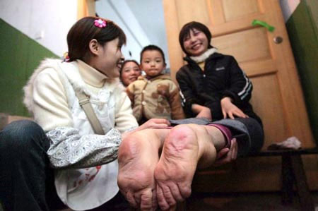 Picture 1 of Girl has strange reverse feet