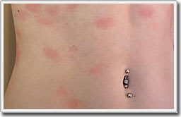 Picture 2 of Girl with allergies to water