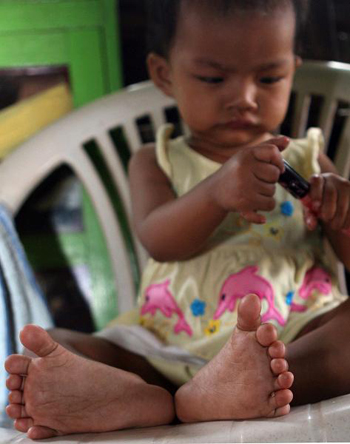 Picture 1 of Girls have 14 toes