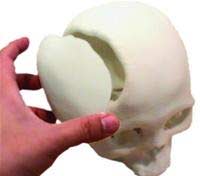 Picture 2 of Give back to patients with skull defects