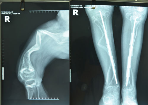 glass-bone-disease