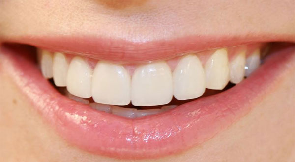 Picture 1 of Guess the personality and guess the disease through teeth