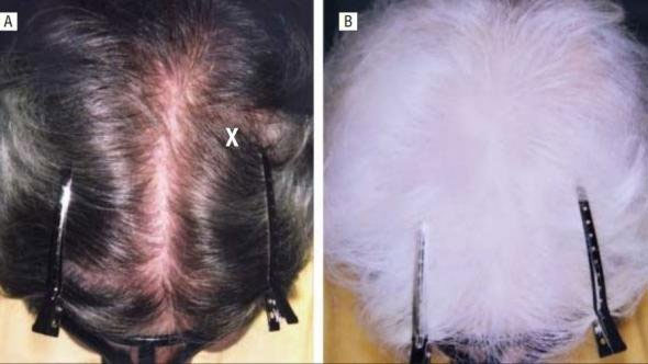 Picture 3 of Hair color change syndrome named the most beautiful woman in Europe