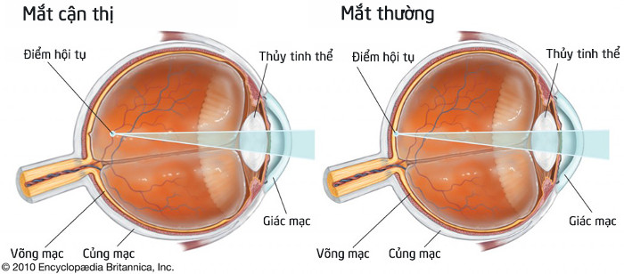 Picture 2 of Half the world's population will suffer nearsightedness by 2050