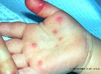 Picture 1 of 'Hand, foot, mouth' disease and prevention