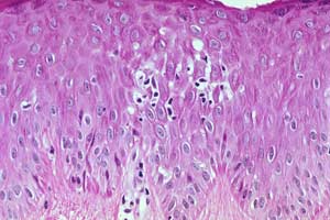 Picture 2 of 'Hand, foot, mouth' disease and prevention