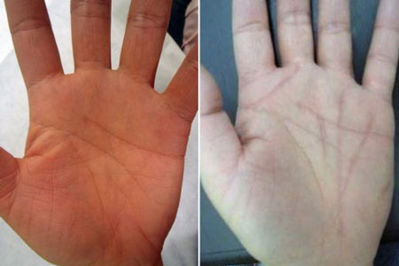Picture 2 of Hand surgery to change fate