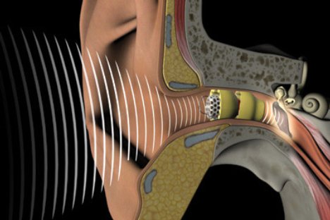 Picture 1 of Hearing is associated with an increased risk of dementia