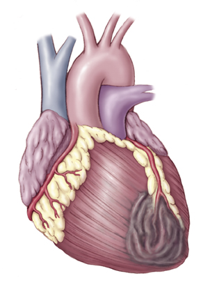 Picture 1 of Heart disease risk meter