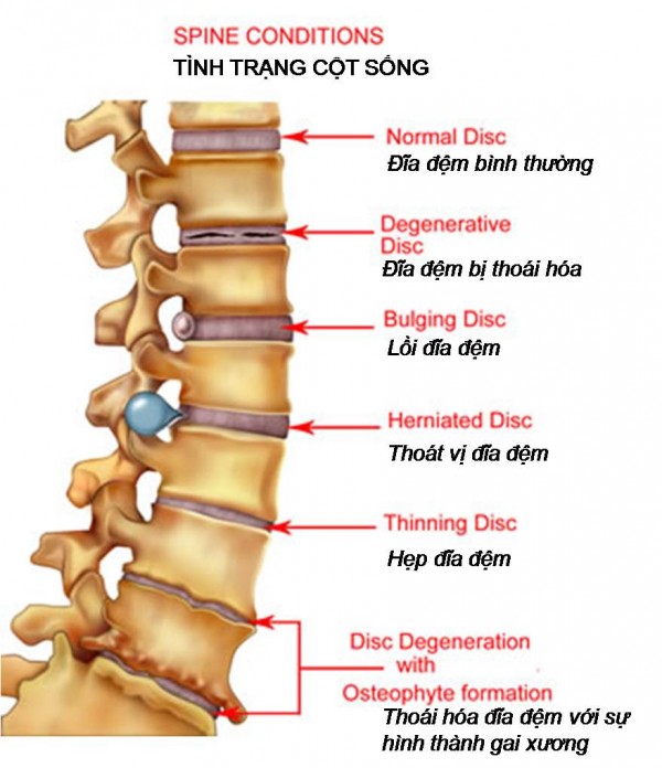 Picture 1 of Hemp bone lumbar spine, an expression of spinal degeneration