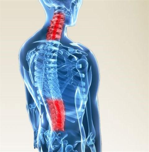 Picture 2 of Hemp bone lumbar spine, an expression of spinal degeneration