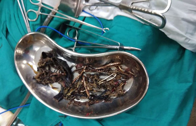 Picture 1 of Hero of 1.5kg metal found in a woman's stomach