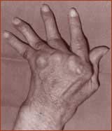 Picture 1 of High cholesterol, a warning sign of rheumatoid arthritis