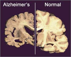 Picture 1 of High magnetic field exposure increases the risk of Alzheimer's disease