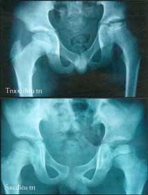 Picture 1 of Hip pain in children