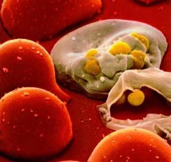 Picture 1 of HIV virus can hide in the bone marrow